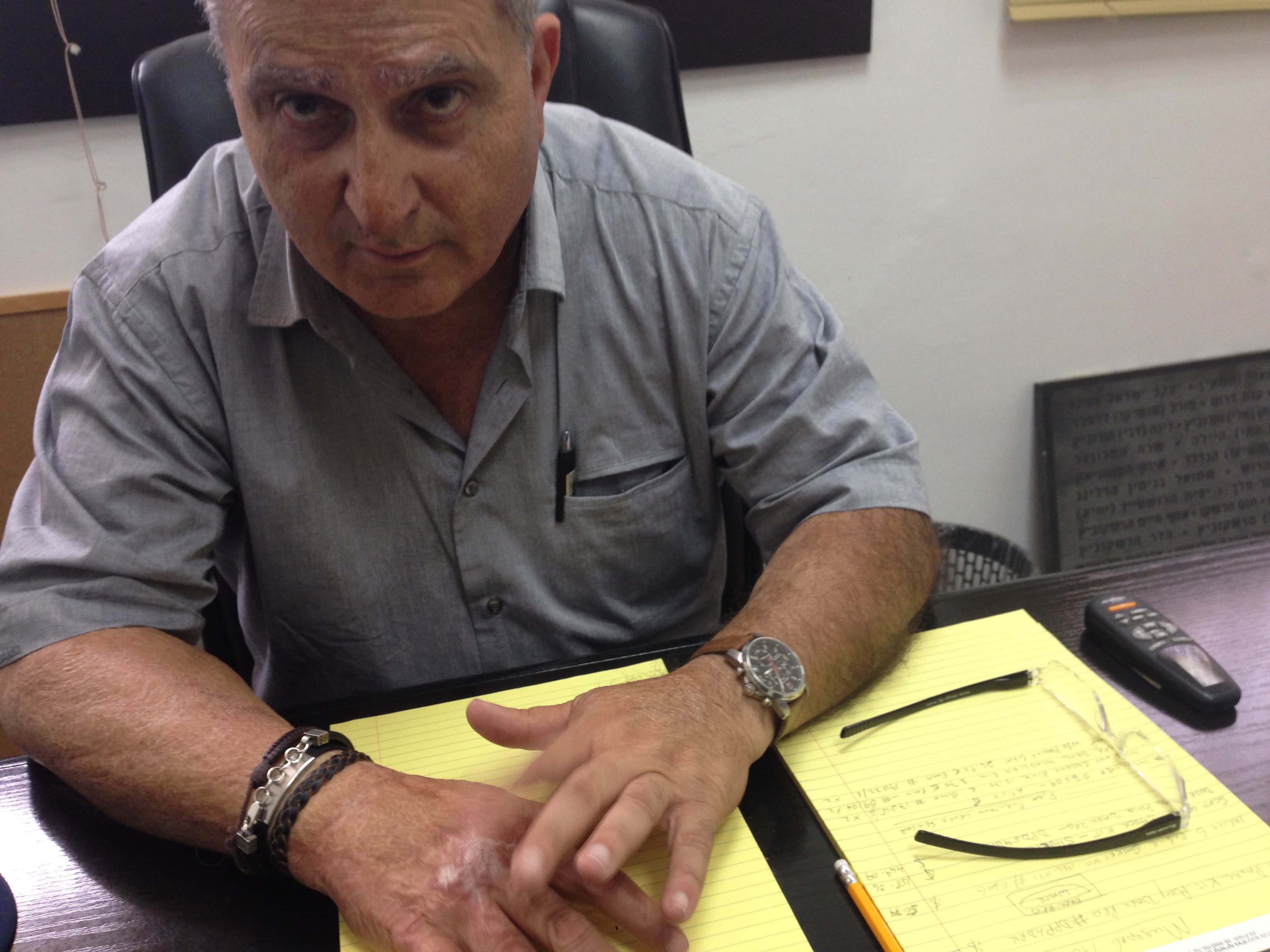 Abie Moses and scars from the burns he suffered in the 1987 firebomb attack that killed his wife and 5-year-old son.