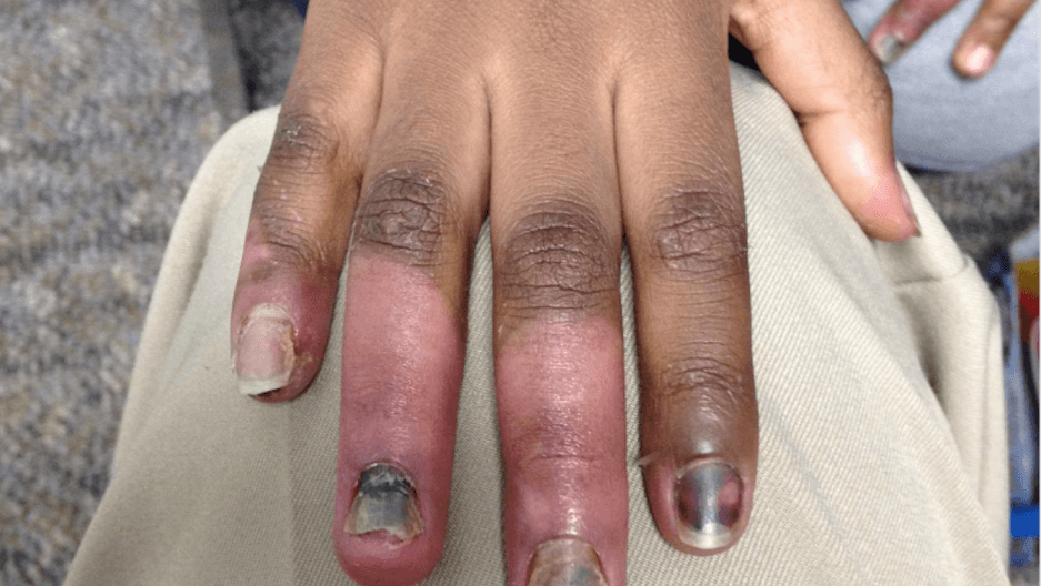 An extreme case of frostbite suffered by a patient of Dr. Paul Caulford at the Canadian Centre for Refugee and Immigrant Healthcare.