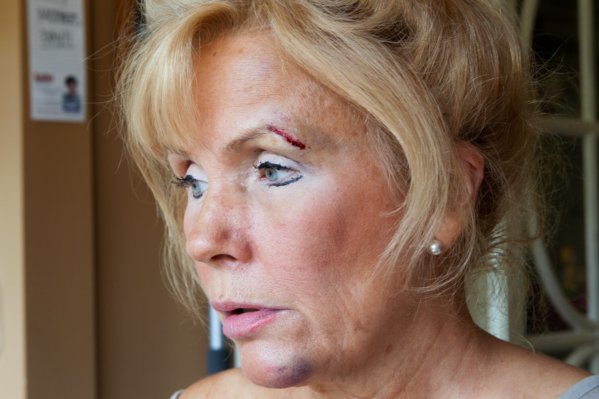 ”I fell down and broke my jaw,” 2012