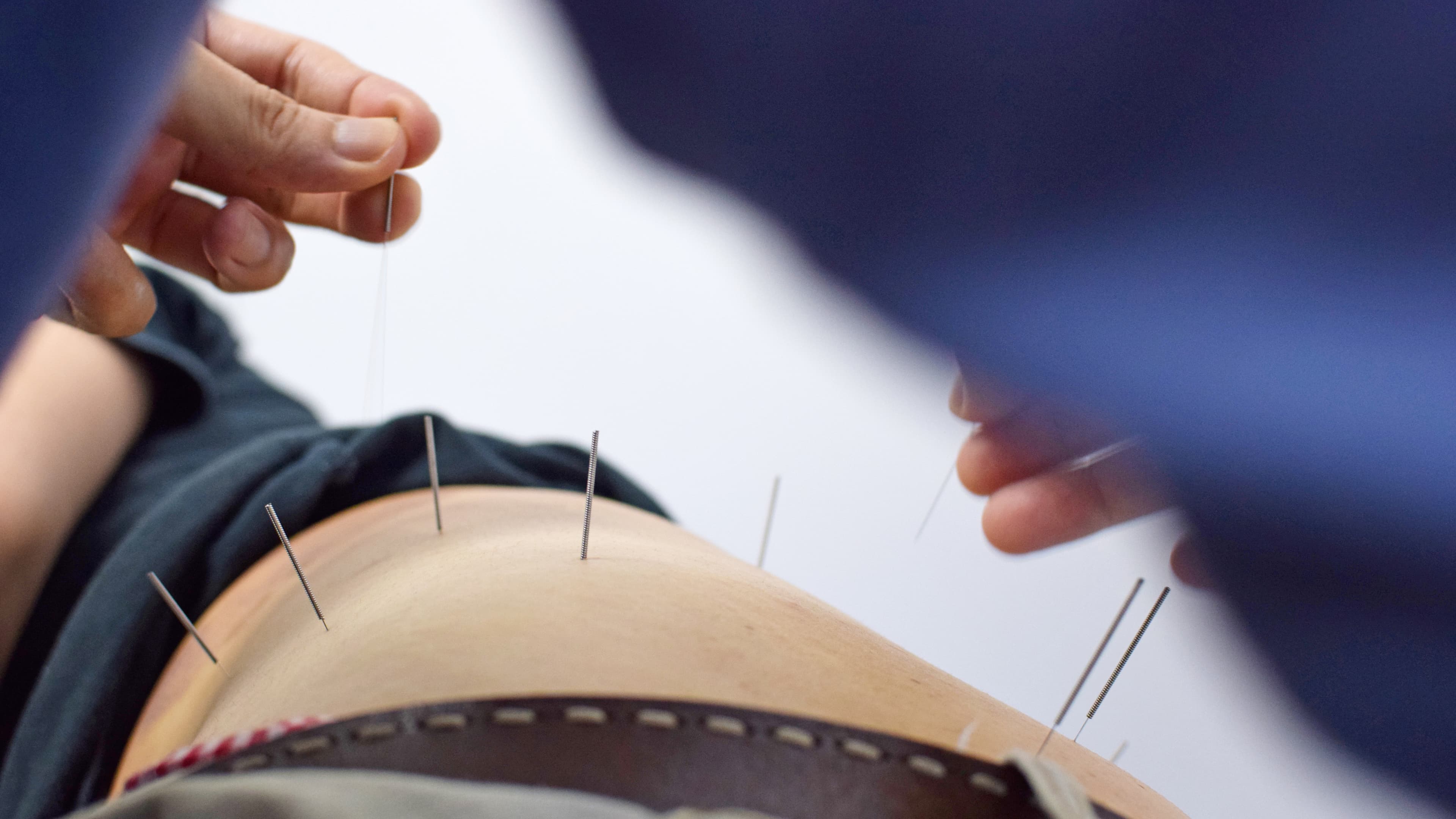 closeup of an acupuncturist's hands inserting needles