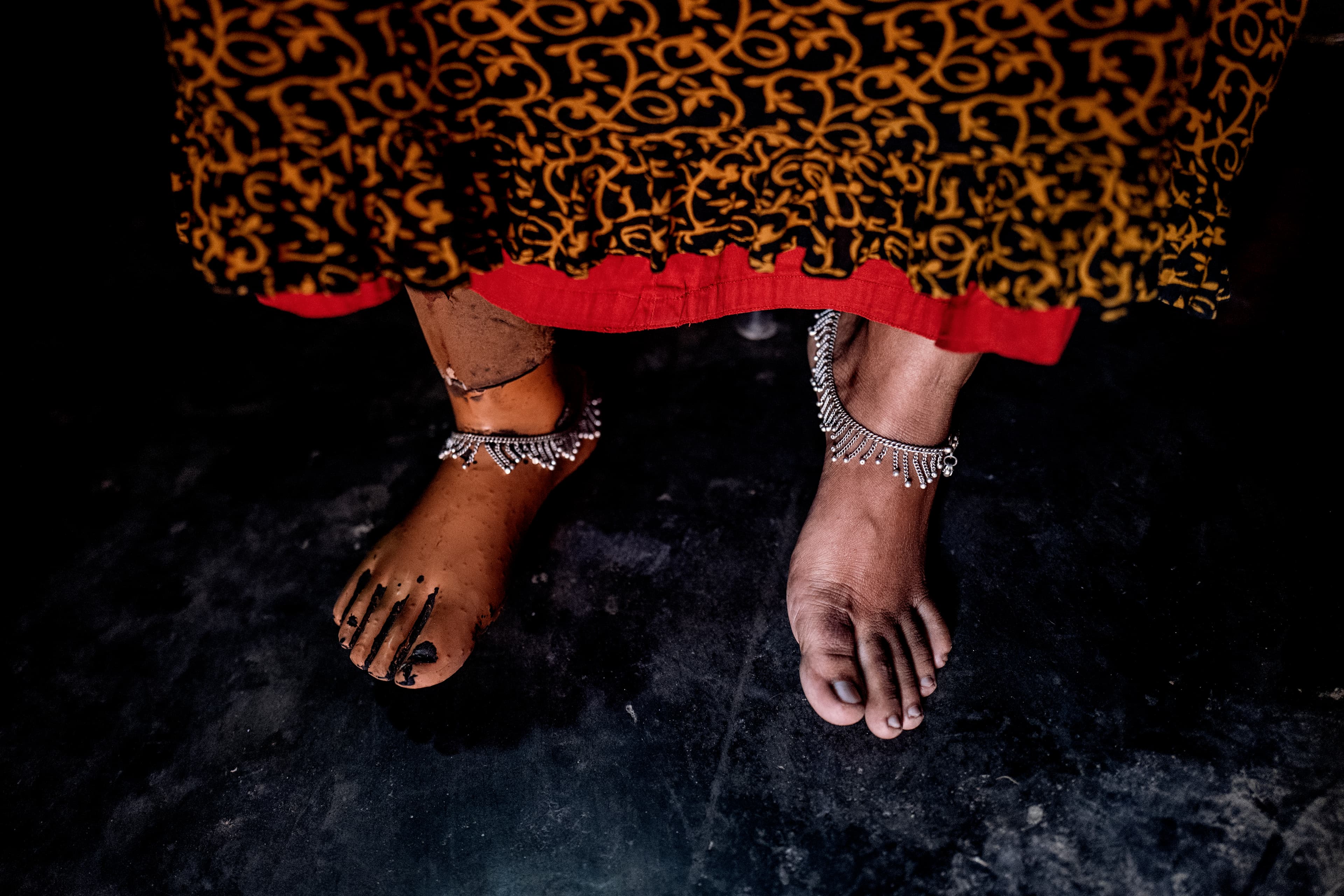 Close up of Arati Baladas' feet. She has a prosthetic foot.
