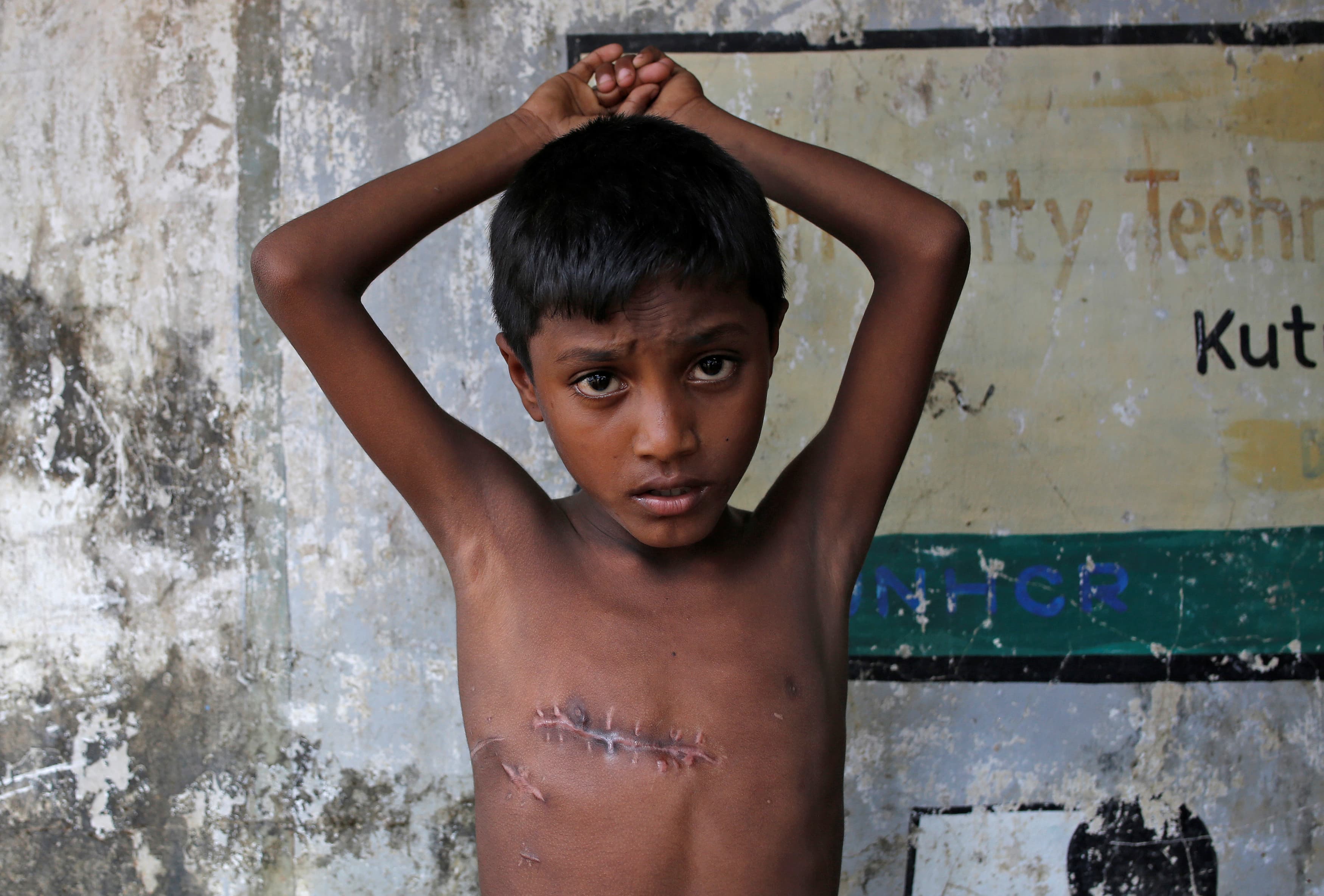 Mohammed Shoaib, 7, who was shot on his chest before crossing the border from Myanmar in August, shows his injury
