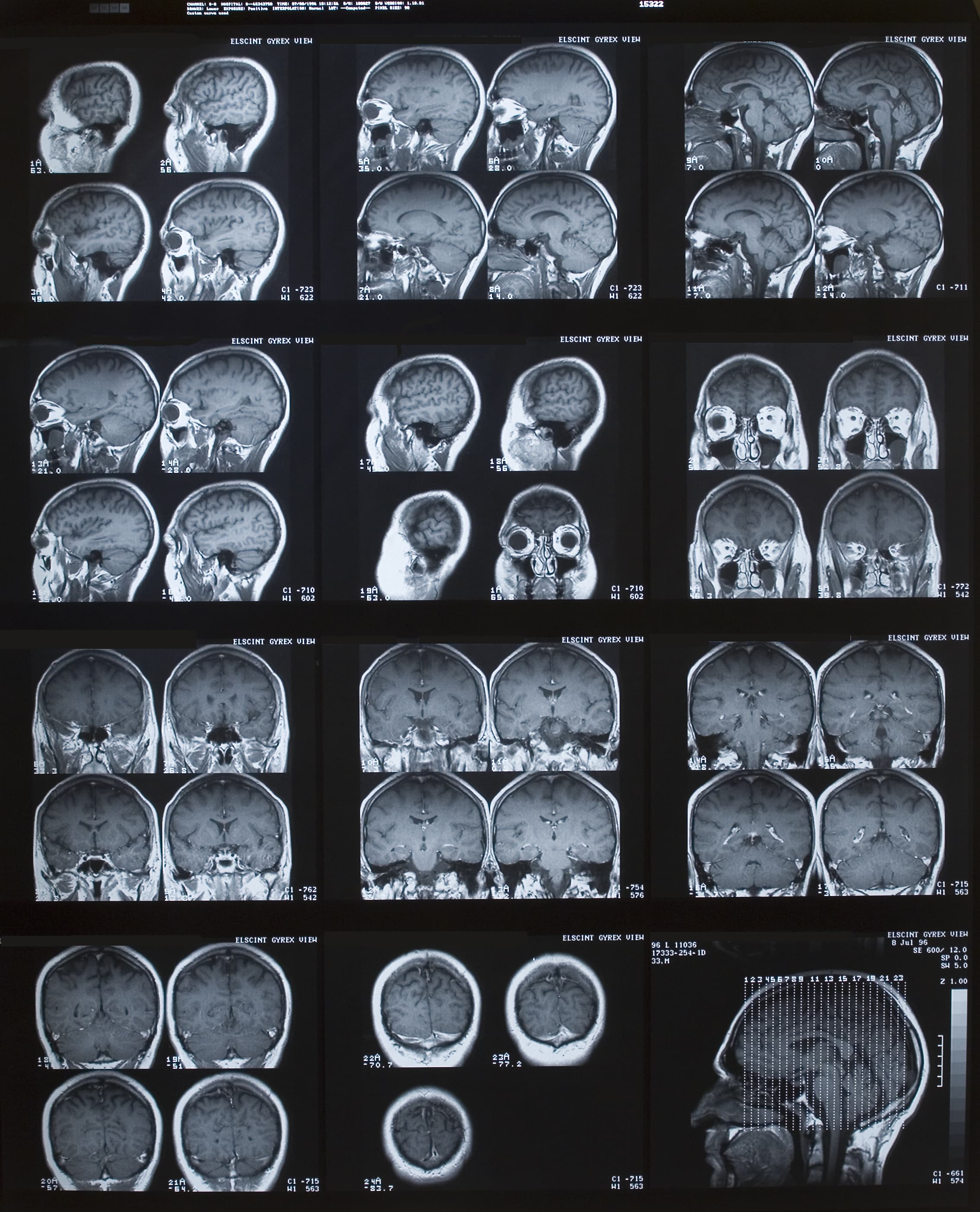 MRI of the brain