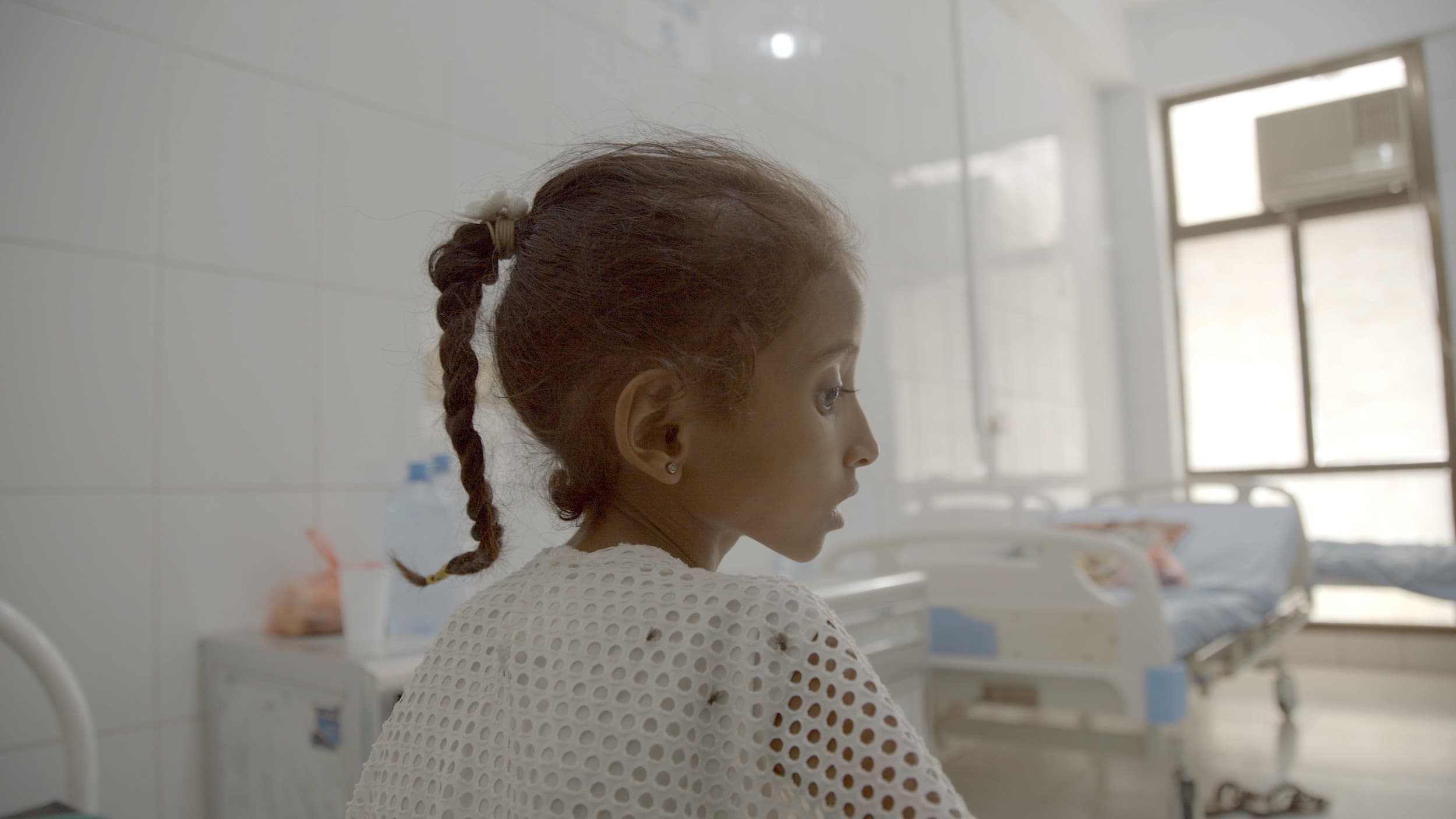 A Yemeni child suffering from malnutrition