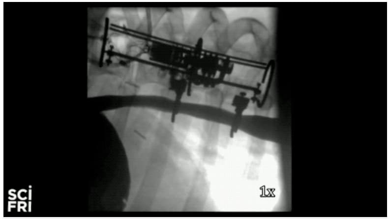 A soft robotic system that gently tugged on the esophagus of a pig proved to elongate the organ by 10 millimeters.