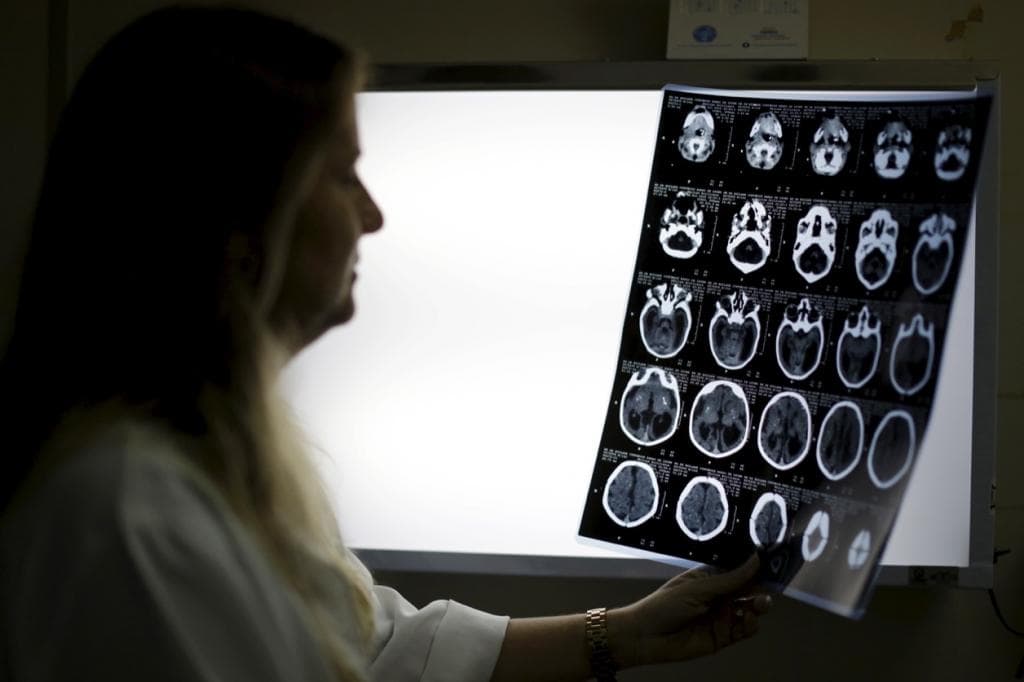 Child neurologist Vanessa Van Der Linden checks X-rays of a baby's skull with microcephaly at the hospital Barao de Lucena in Recife, Brazil, Jan. 26.