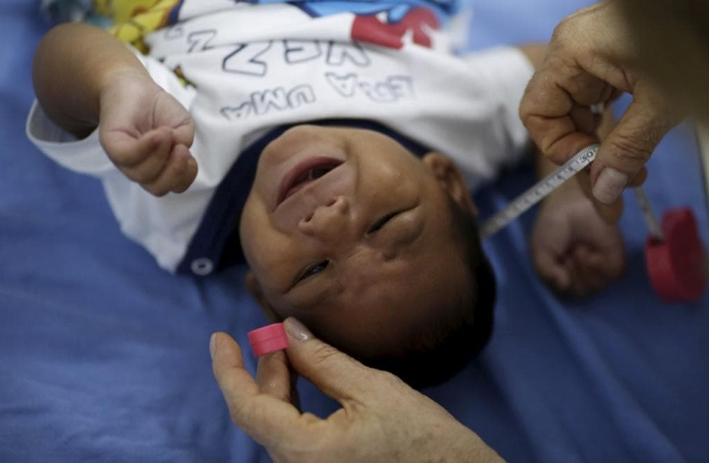 Alessandro Gomes, who has microcephaly, has his head measured by a neurologist at the Oswaldo Cruz Hospital in Recife, Brazil, Jan. 26.
